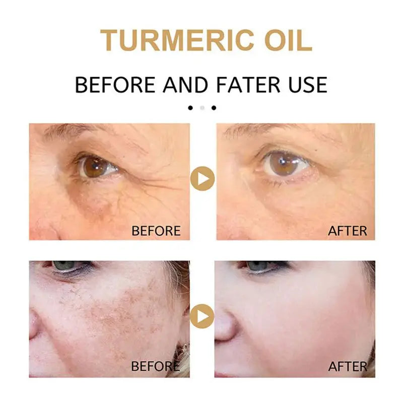 Turmeric Freckle Whitening Serum Fade Dark Spots Removal Pigment Melanin Correcting Facial Beauty Face Skin Care Products 30ml