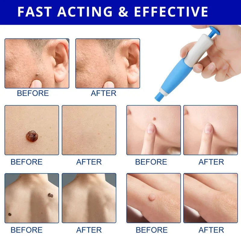 Skin Tag Remover Kit Mole Wart Remover Equipment Skin Tool
