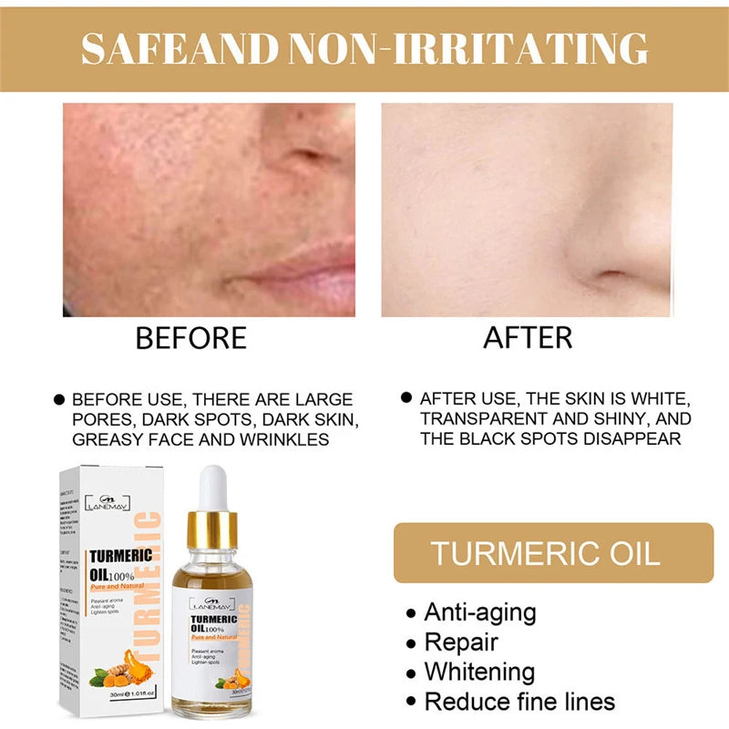 Turmeric Freckle Whitening Serum Fade Dark Spots Removal Pigment Melanin Correcting Facial Beauty Face Skin Care Products 30ml
