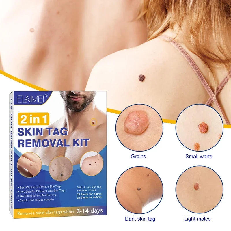 Skin Tag Remover Kit Mole Wart Remover Equipment Skin Tool