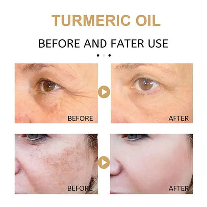 Turmeric Freckle Whitening Serum Fade Dark Spots Removal Pigment Melanin Correcting Facial Beauty Face Skin Care Products 30ml