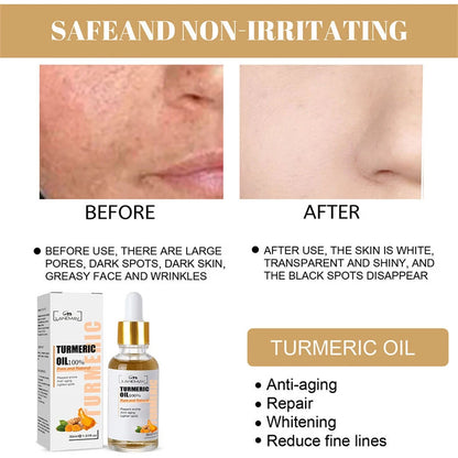 Turmeric Freckle Whitening Serum Fade Dark Spots Removal Pigment Melanin Correcting Facial Beauty Face Skin Care Products 30ml